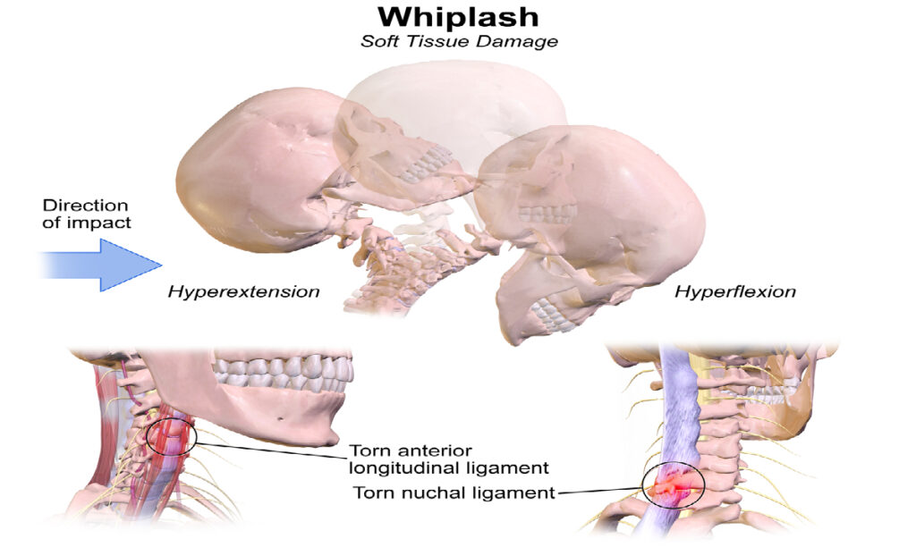 whiplash_