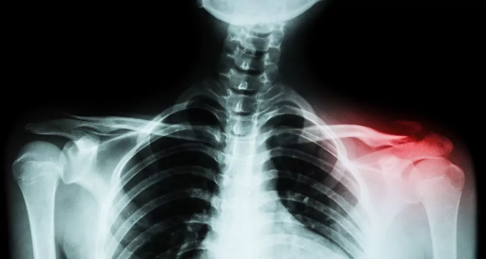 clavicle injury xray