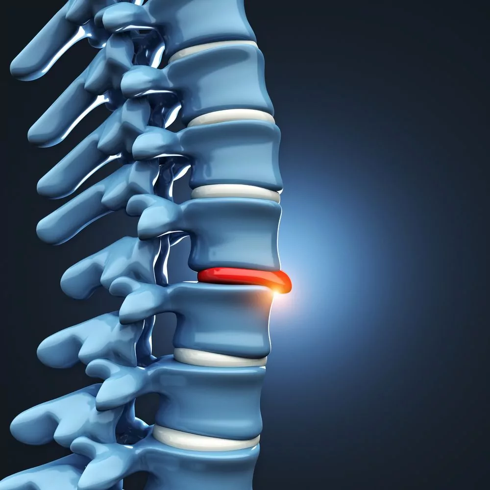 Herniated Disc Injury - Learn More Today!