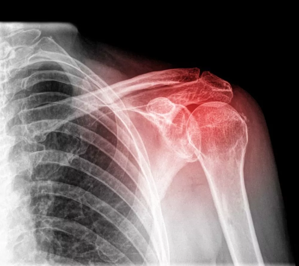 shoulder injury xray