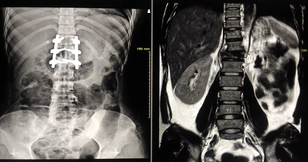 spinal injury xray