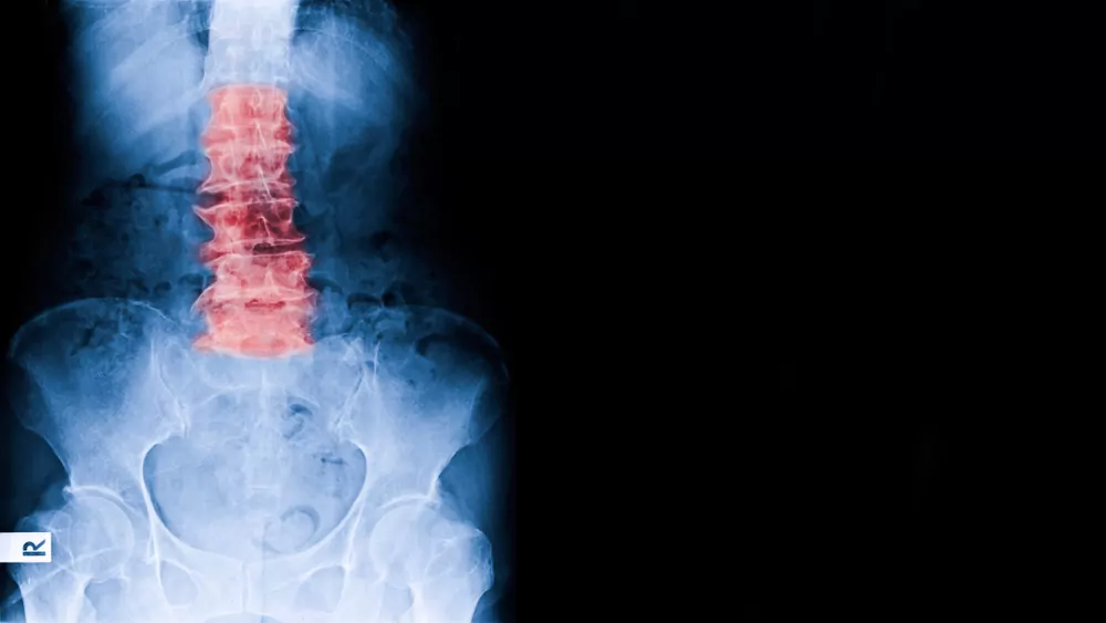 annular spine injury xray