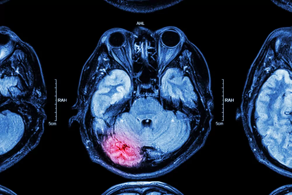 brain mri scan