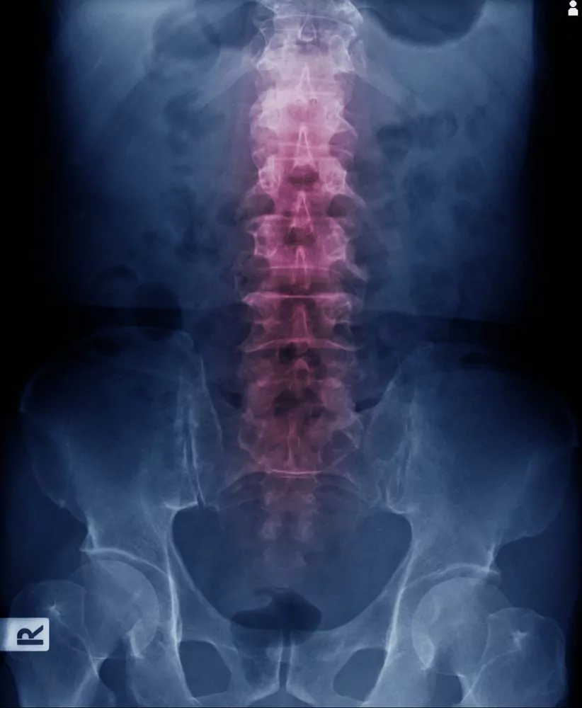 spinal compression fracture xray